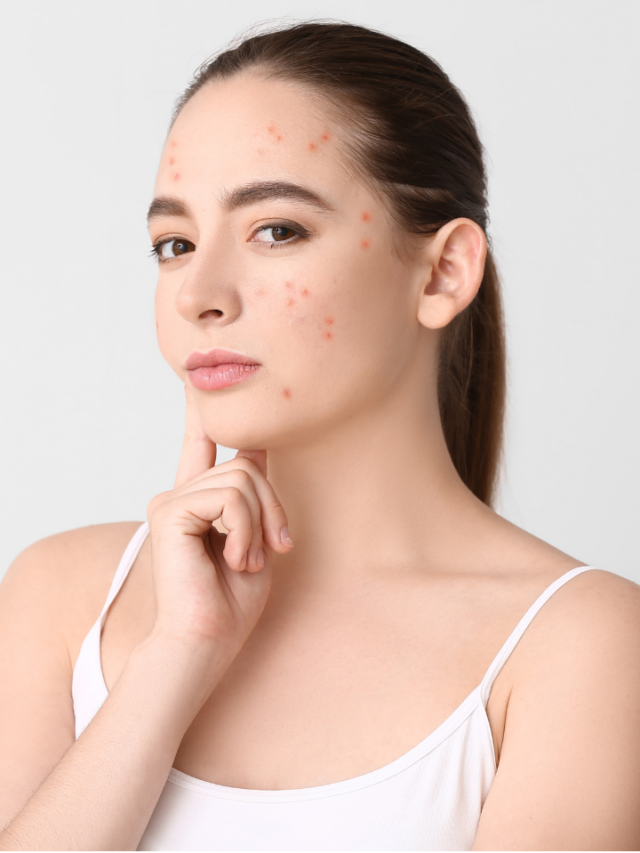 3 Powerful Steps to Cure Acne Naturally in 3 Days! Unlock Clear Skin Fast!